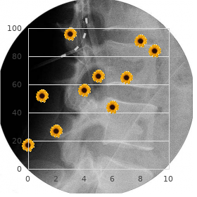 Radial ray agenesis