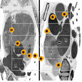 Reperfusion injury