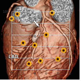 Periodic limb movement disorder