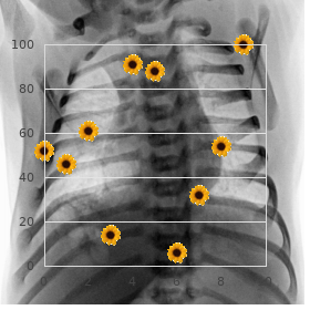 Multiple myeloma