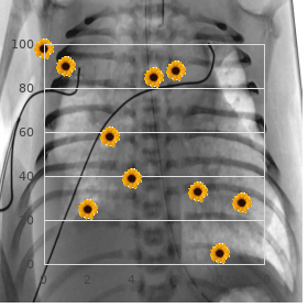 Hodgkin lymphoma