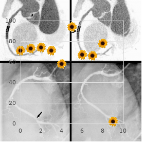 Spastic paraplegia nephritis deafness